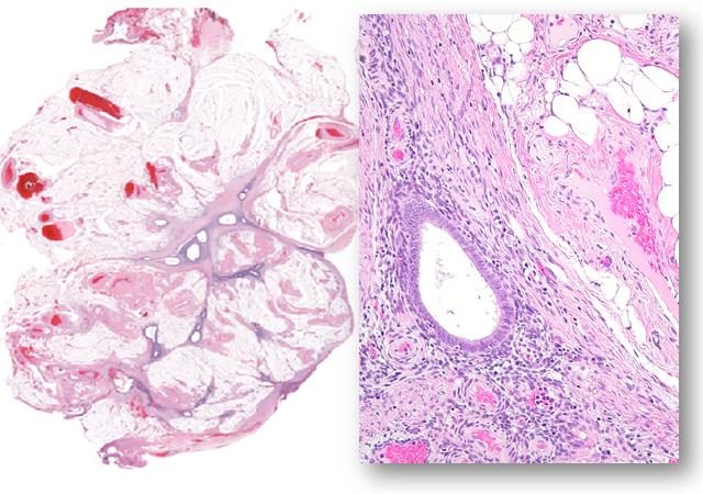 Endometriosis