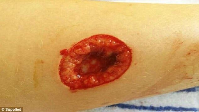 Jack Tolley lost a chunk of flesh from his calf stretching 73mm in diameter after he was bitten by a rare shark