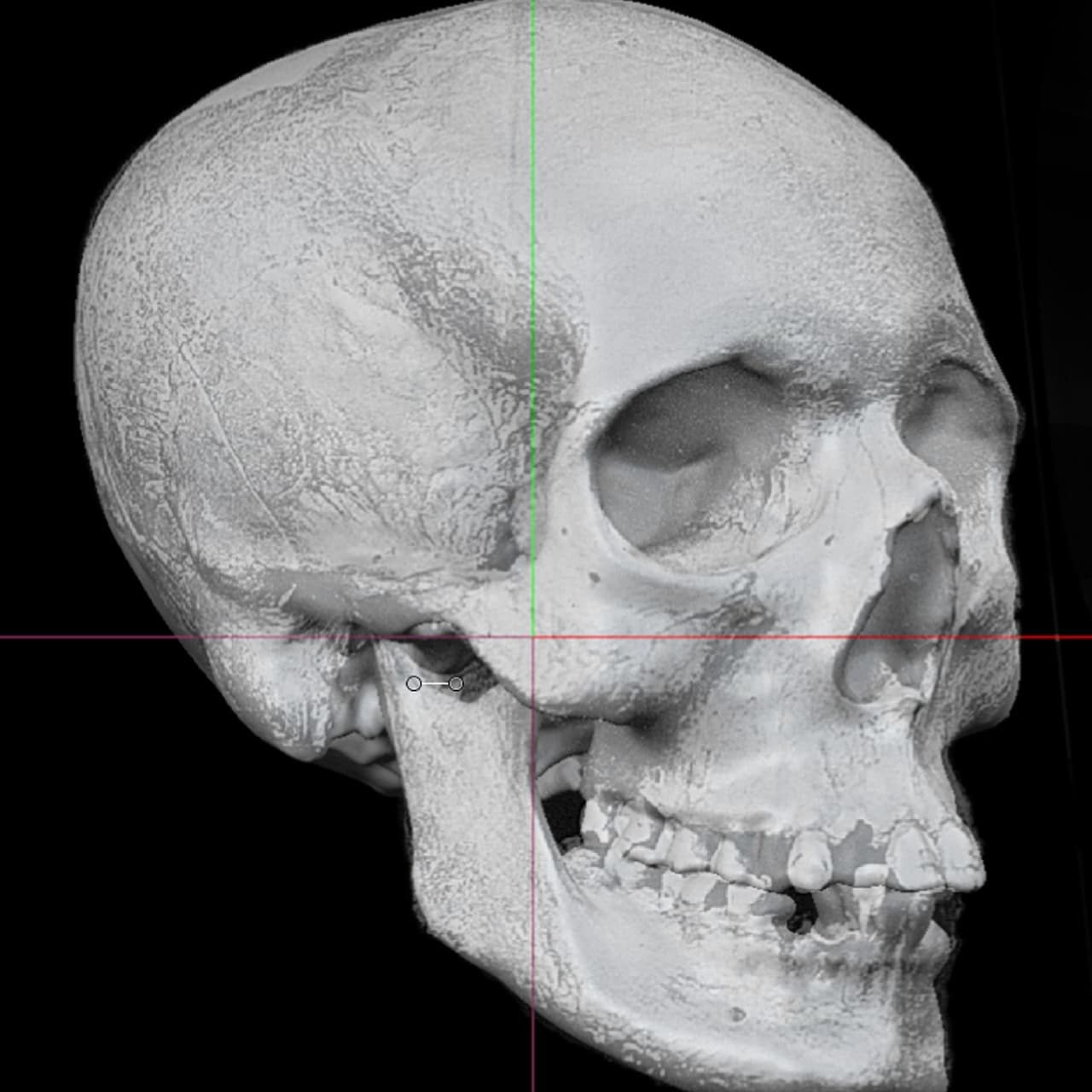 Click to enlarge Adie's skull was photographed before it went missing Face of 'witch' who died before she could be burned for her 'crimes' is digitally reconstructed 300 years later