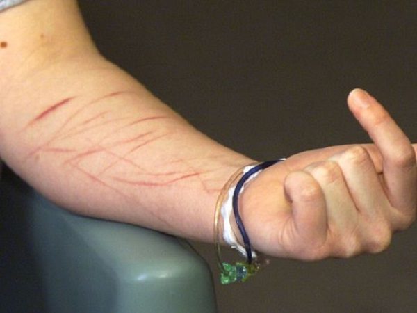 Click to enlarge Scars