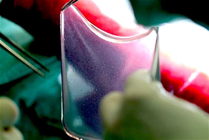 Click to enlarge stem cell graft