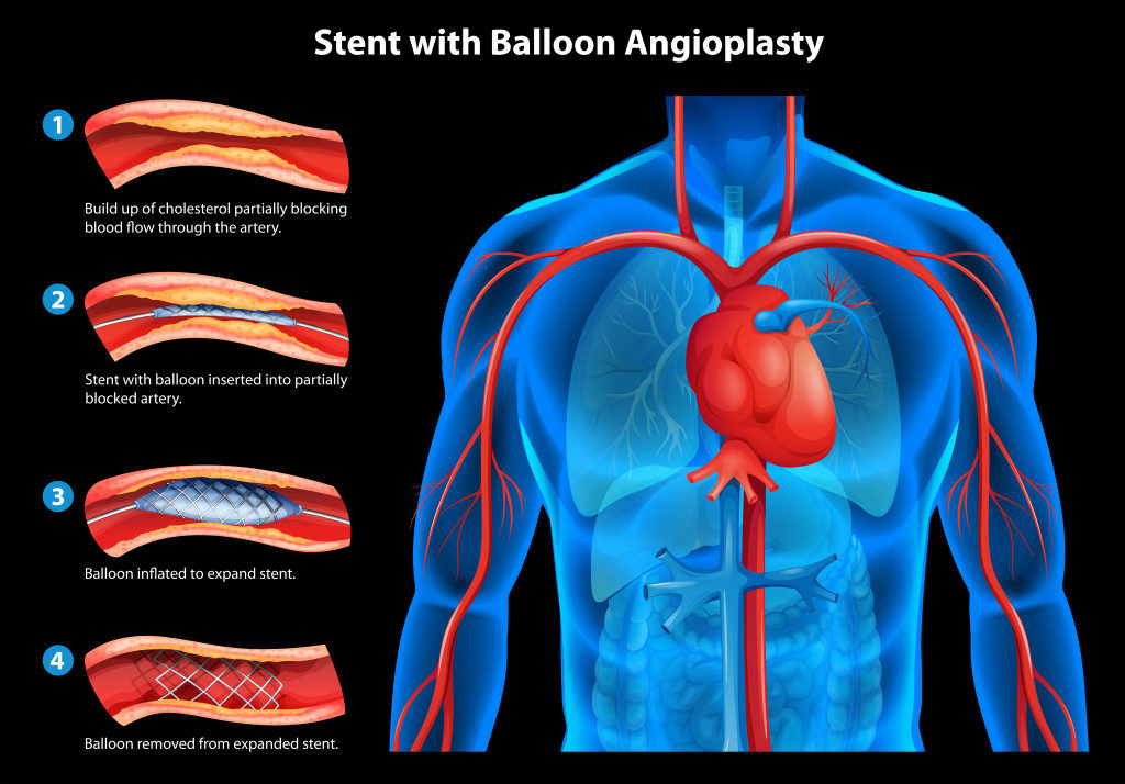 Click to enlarge stent, angioplasty
