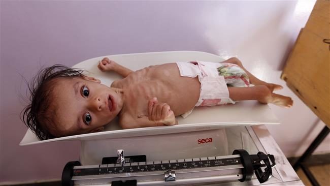 Click to enlarge yemen malnourished child