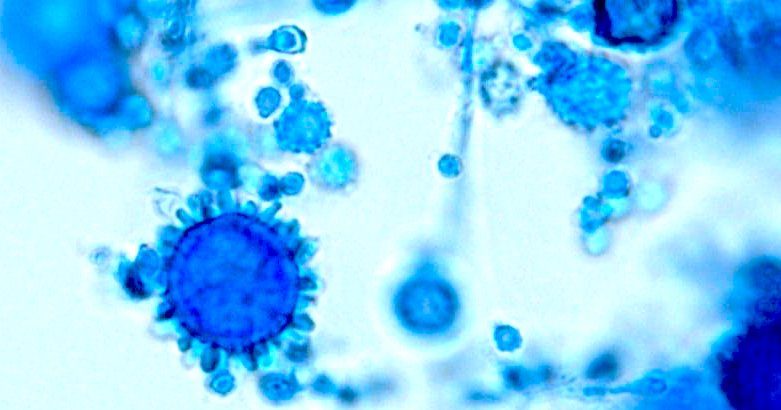 Click to enlarge histoplasmosis