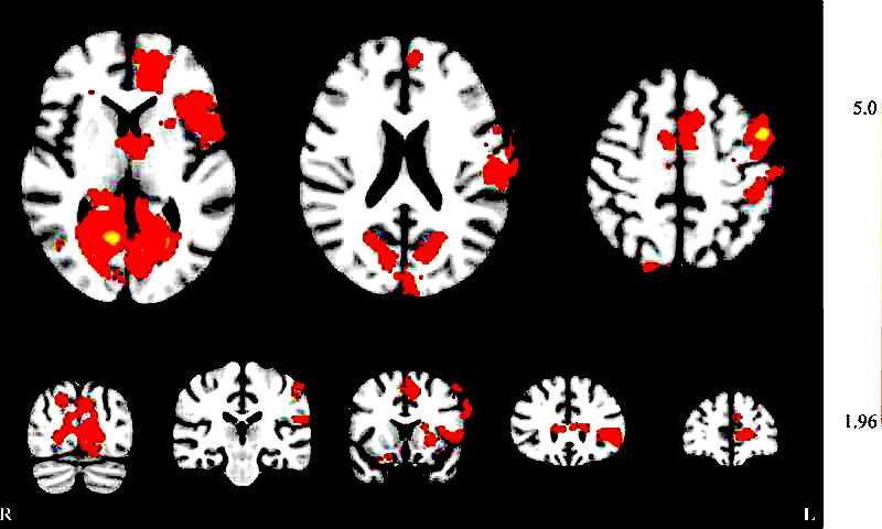 Click to enlarge neurofeedback effects