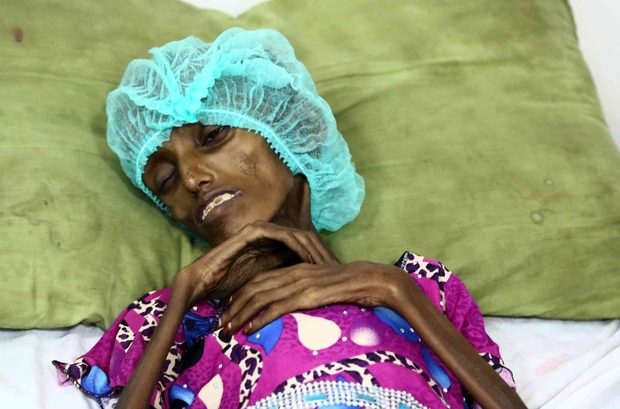 Yemen malnutrition hunger