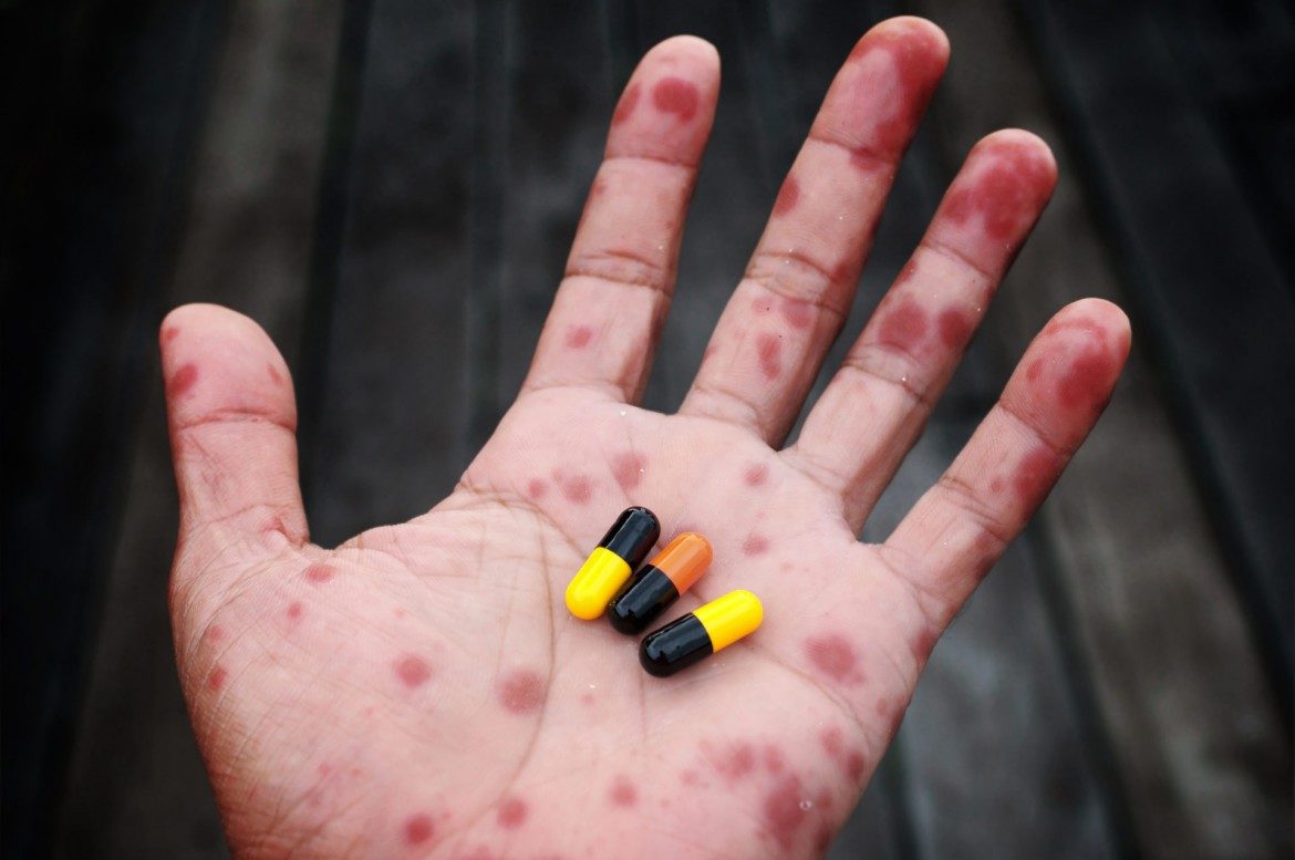 scarlet fever