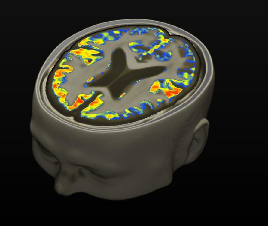 Iron levels brain