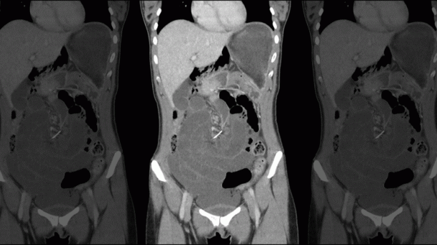 Dental brace in woman's intestine