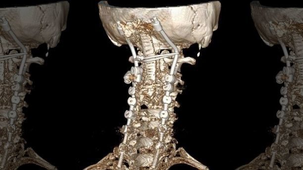 Ehlers Danlos Syndrome