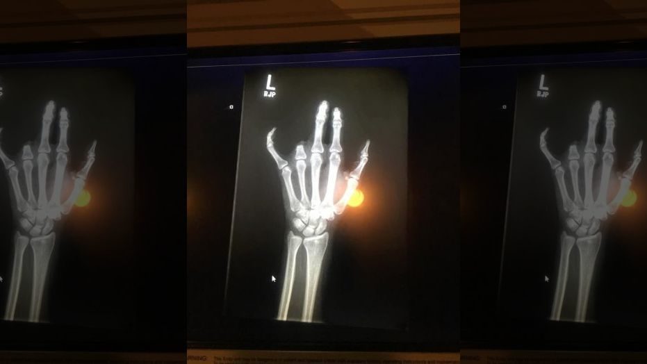 missing finger xray