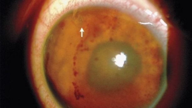 Click to enlarge eye worm