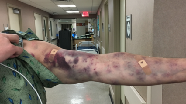 Click to enlarge mystery bug bite