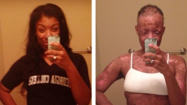 skin burned from medication