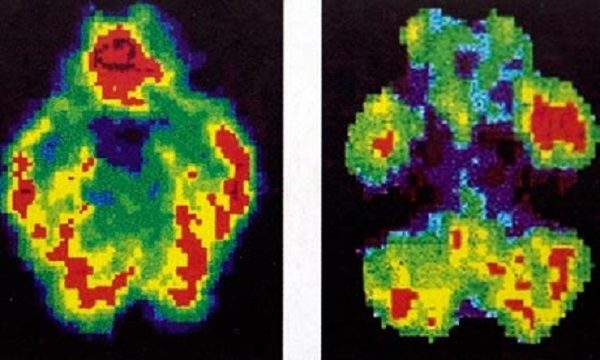 Normal brain vs. murderer's brain