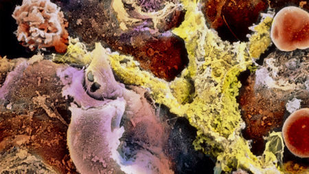 overgrowth of connective tissue