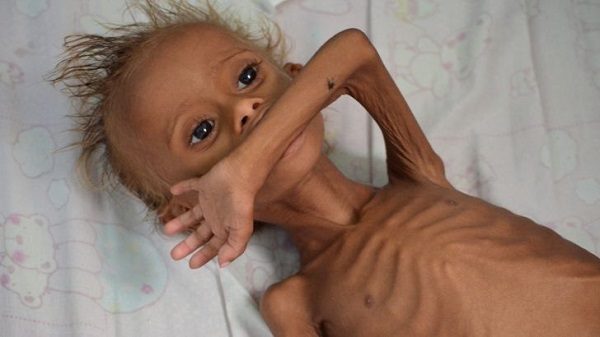 Starving Yemeni child