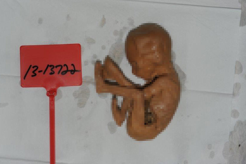 fetus