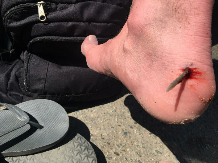 Click to enlarge A stinger is lodged in a foot of a victim in Huntington Beach a few weeks ago.
