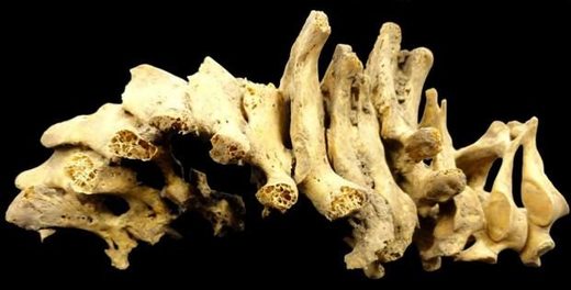 Neck and vertebrae from a child suffering from Pott's disease, a symptom of tuberculosis