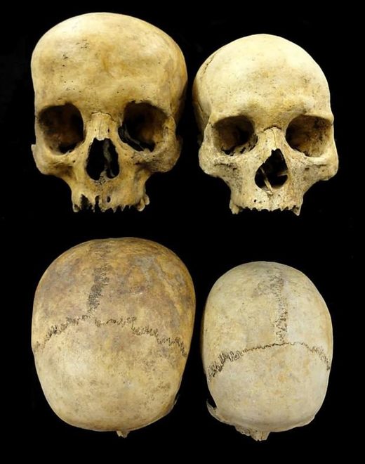 An abnormally large skull found on the island (left) which was probably caused by hydrocephaly.