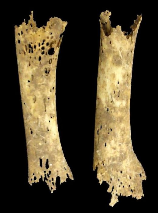The foot bones of a teenager suffering from syphalis were honeycombed