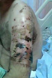 Click to enlarge Dog bite