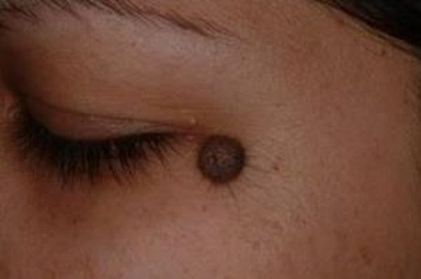 mole on face