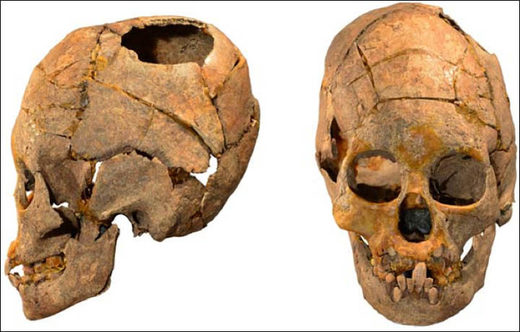 Click to enlarge Siberia was a major centre of early skull surgery in ancient times, say archeologists