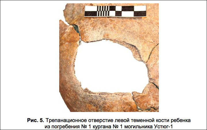 trepanation hole inside