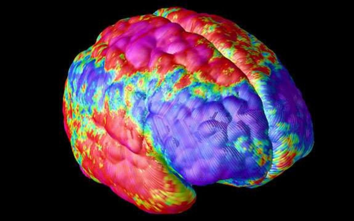 Click to enlarge A false colour image of a brain of a person with schizophrenia. Credit: NIH