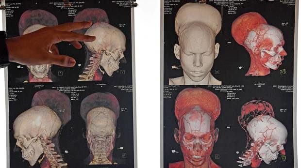 massive brain tumour