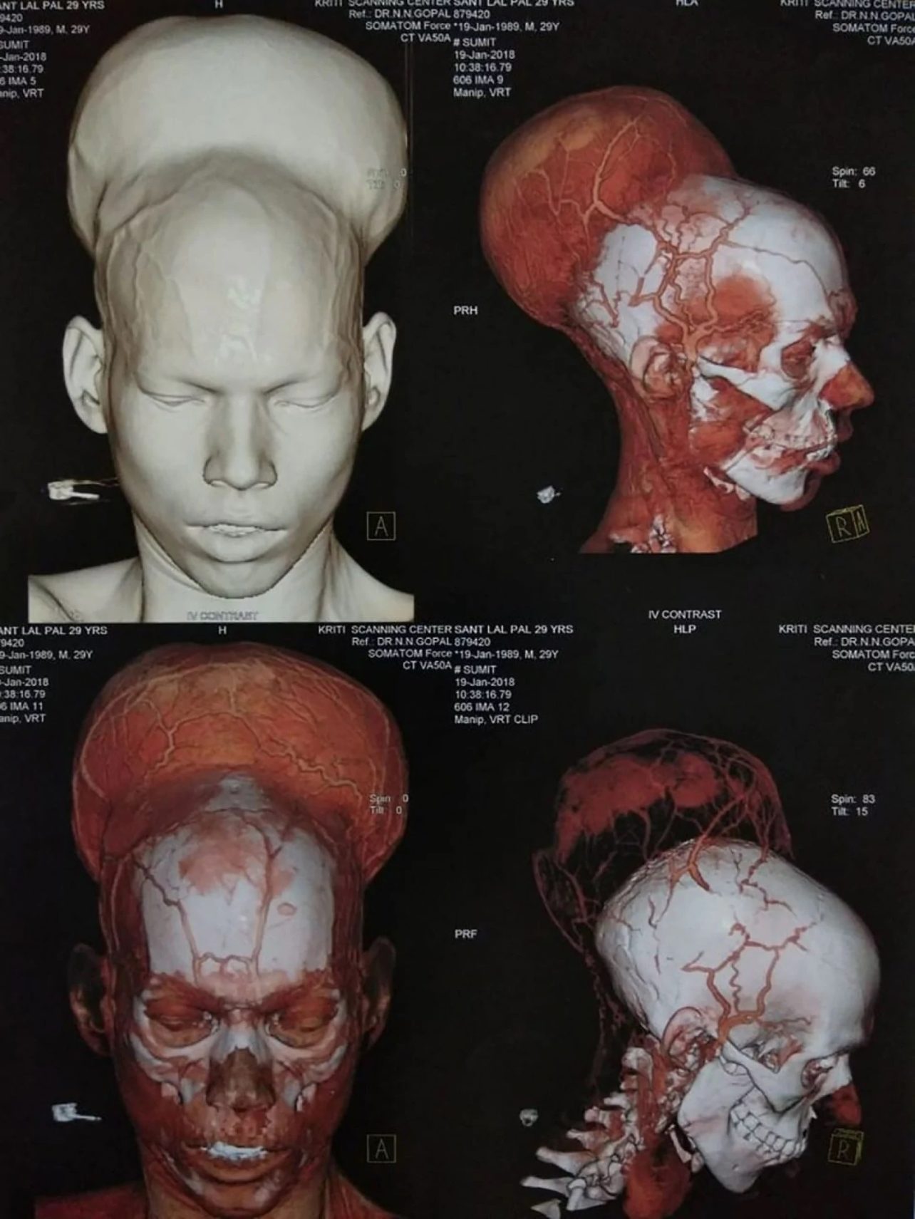 3D image brain tumour
