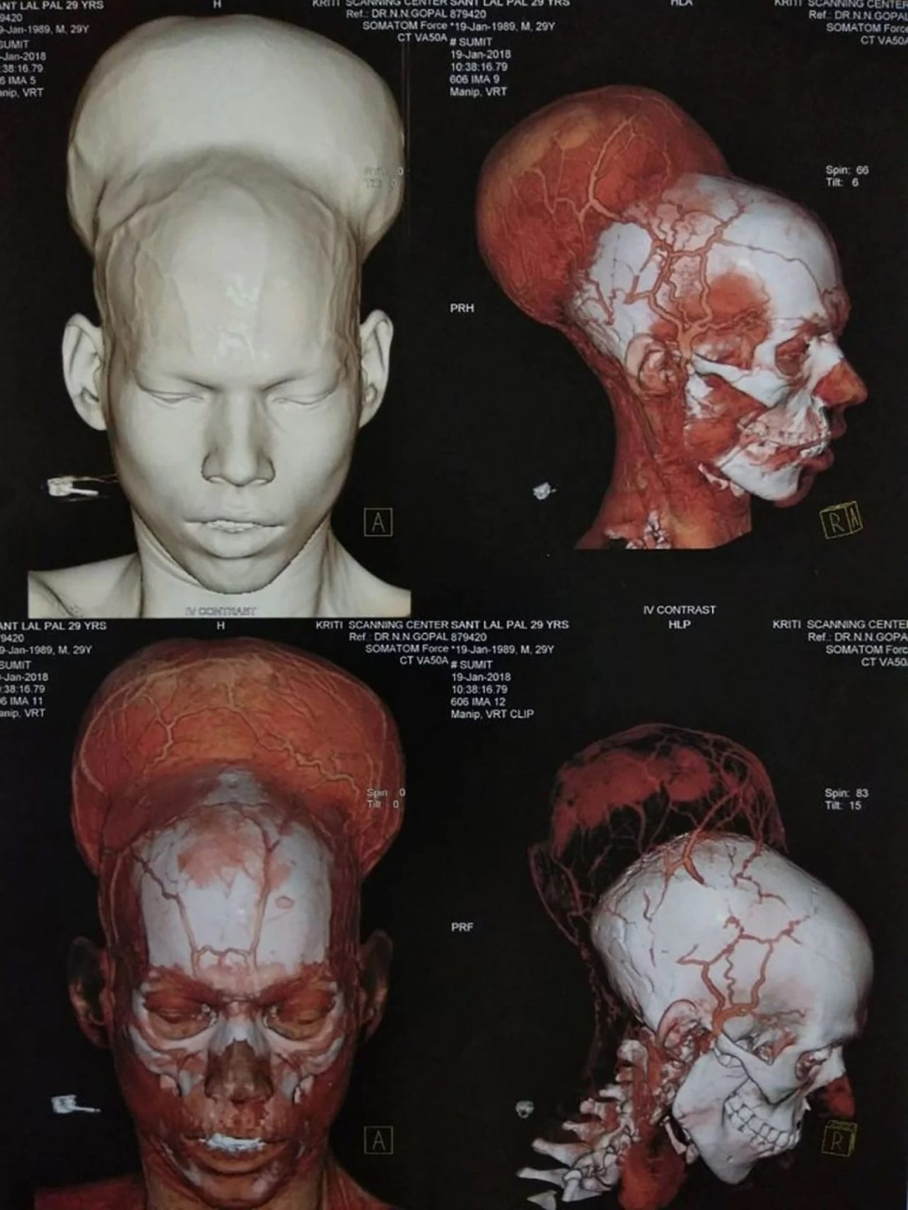 Click to enlarge 3D image brain tumour