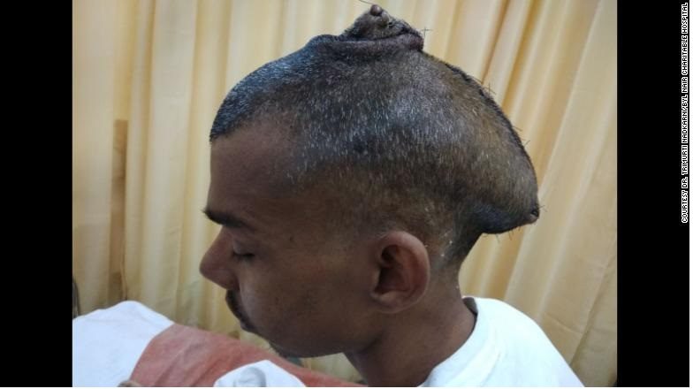 Click to enlarge massive brain tumour removed