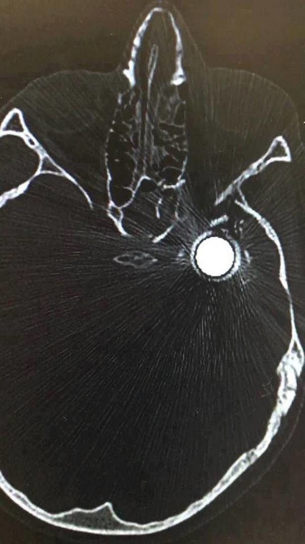 tamimi bullet head cat scan