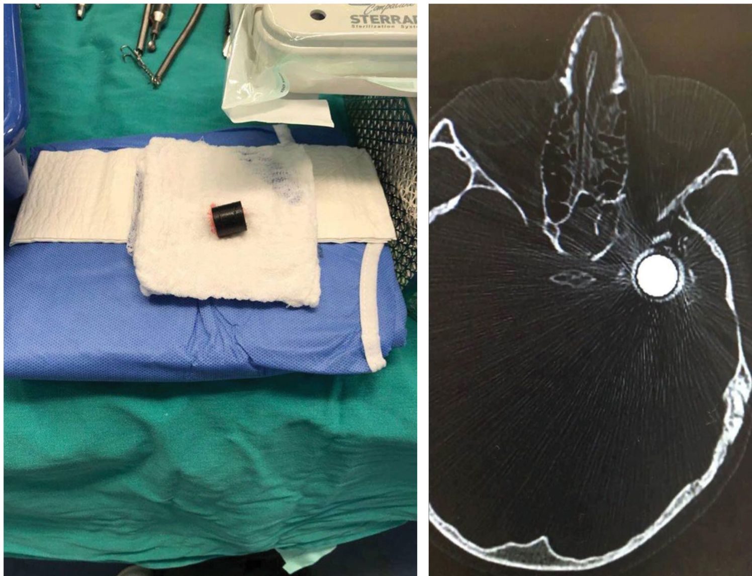 Click to enlarge Mohammed Tamimi bullet CAT scan