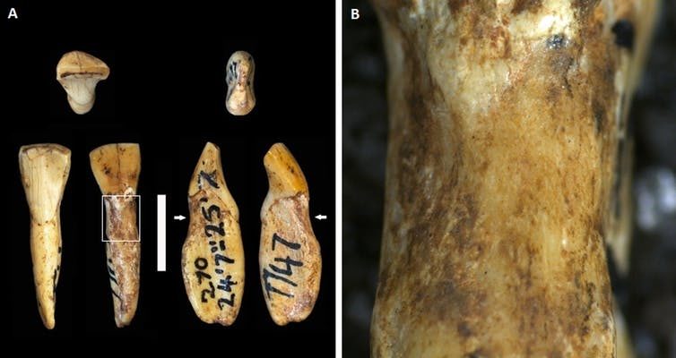 Click to enlarge Australopithecus africanus teeth with lesions.