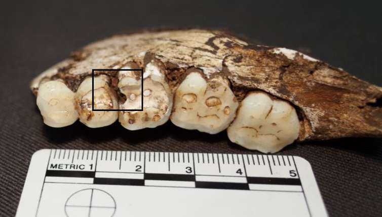Carious lesions on the mandibular right second premolar and first molar. Homo naledi (UW 101-001).