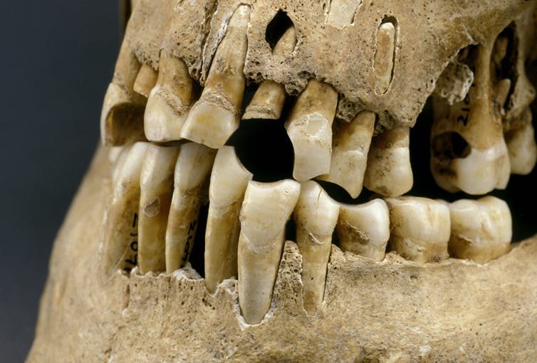 Click to enlarge Example of a notch from a clay pipe (17th century set of teeth).