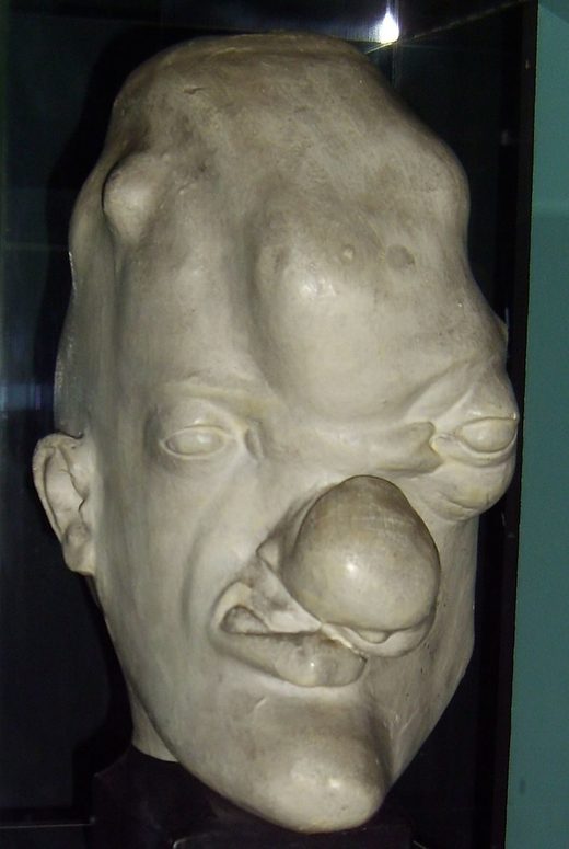 Tertiary syphilis head