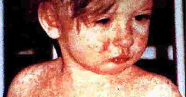 child with measles