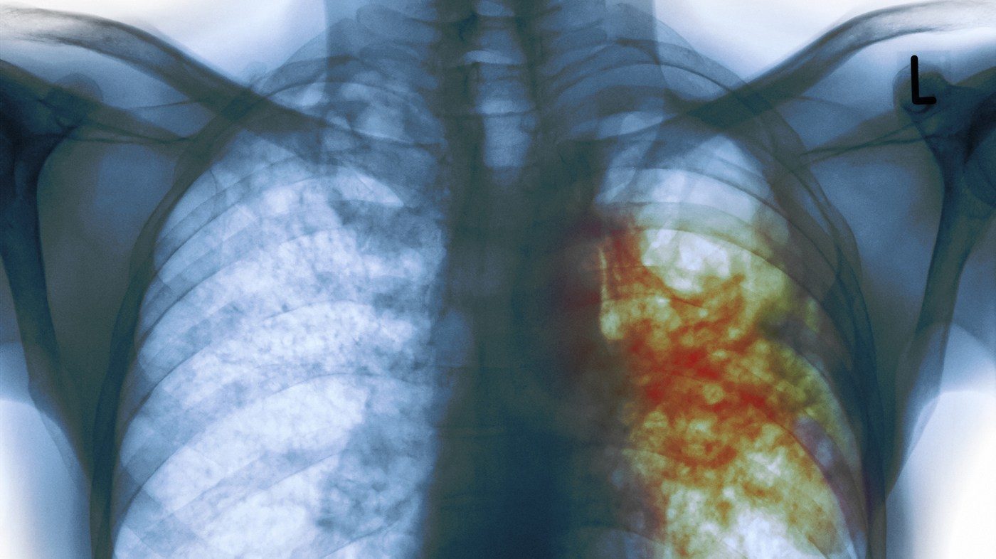 TB, tuberculosis
