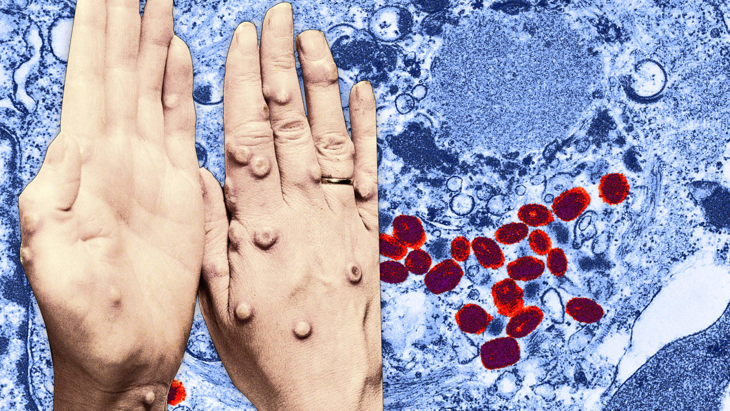 smallpox