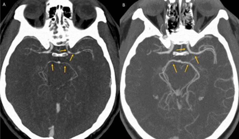 brain scan blood vessel narrowing