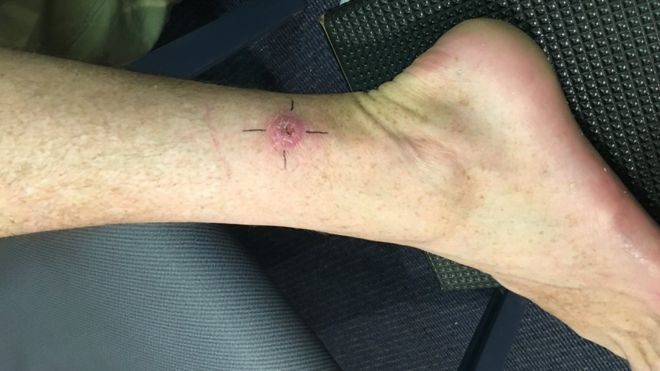 Click to enlarge Buruli ulcer