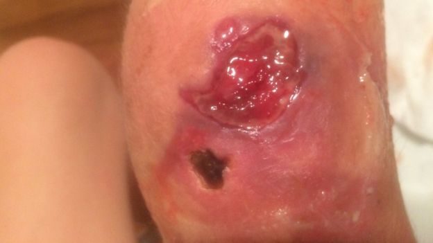 Click to enlarge Buruli ulcer attacking a patient's knee