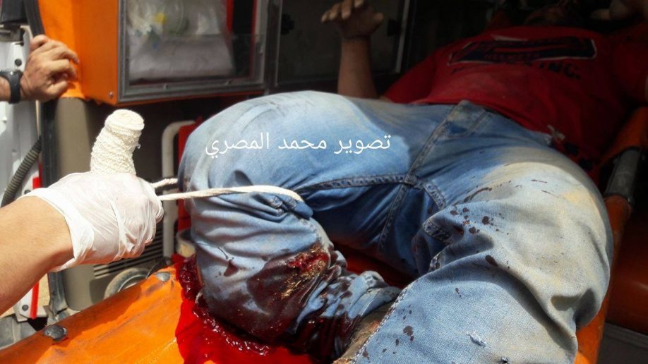 Click to enlarge Wound inflicted by Israeli explosive bullet fire, in Gaza