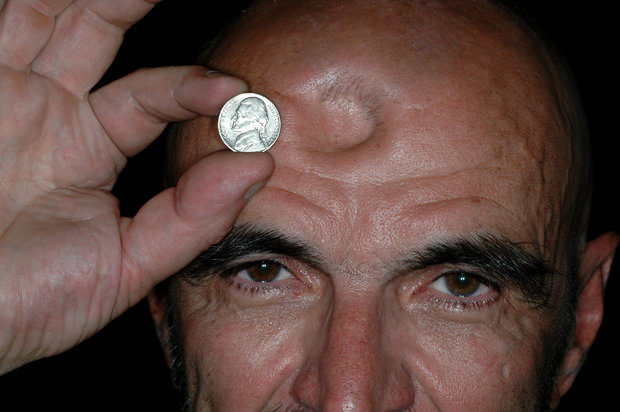 trepanation