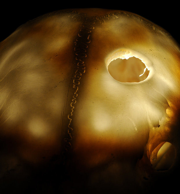 Click to enlarge trepanation